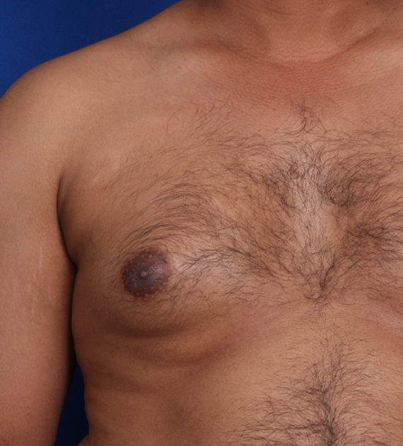 Gynecomastia Consultation Image
